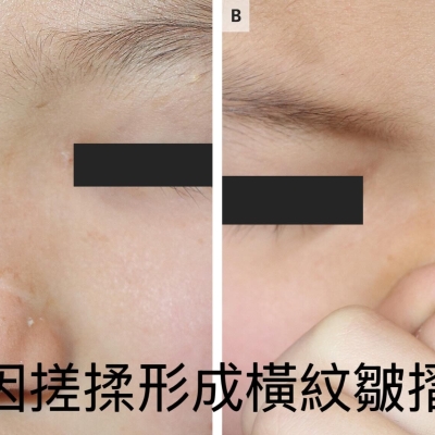 為什麼鼻子上會有一痕?過敏性鼻炎常見特徵大解析...