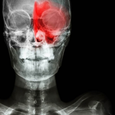 什麼是疼痛鼻(中鼻甲症候群)?使人頭痛欲裂