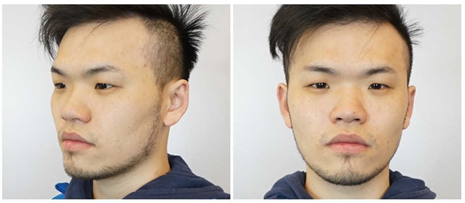 林鴻穎醫師隆鼻 男性鼻整 讓鼻型有自己的個性 林鴻穎醫師隆鼻 男性鼻整 讓鼻型有自己的個性