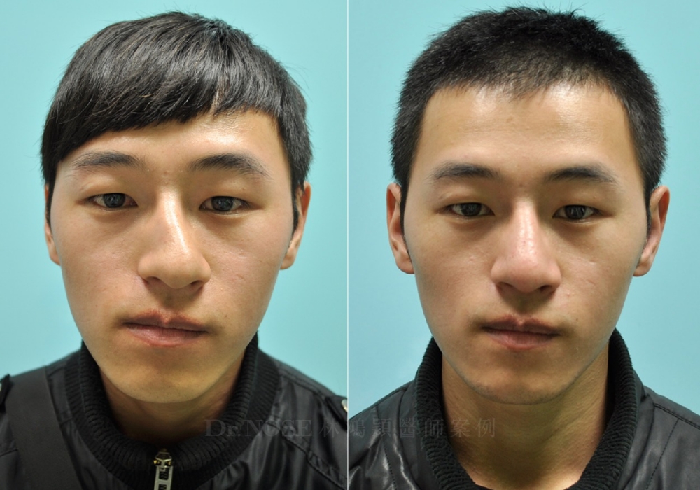 林鴻穎醫師隆鼻 各種鼻型調整 歪鼻手術 林鴻穎醫師隆鼻 各種鼻型調整 歪鼻手術