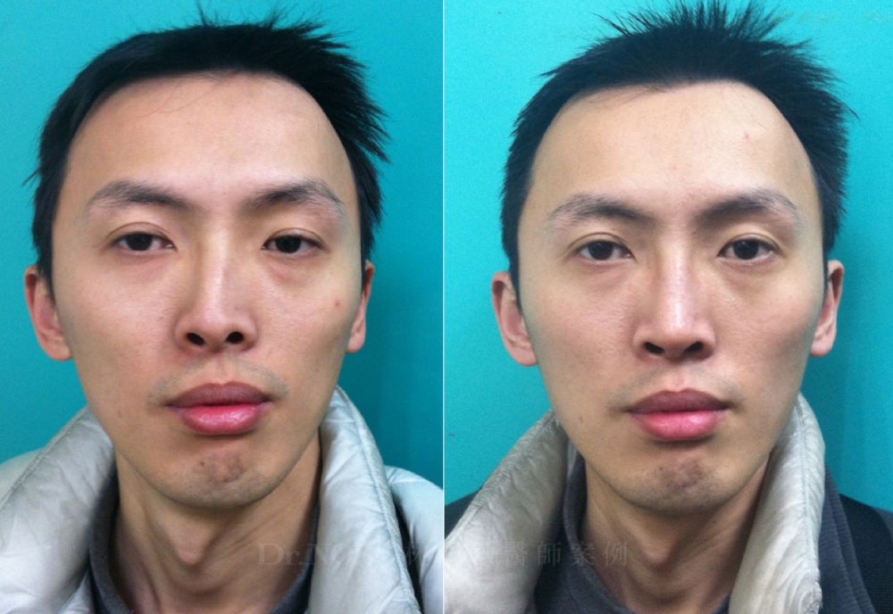 林鴻穎醫師隆鼻 各種鼻型調整 歪鼻手術