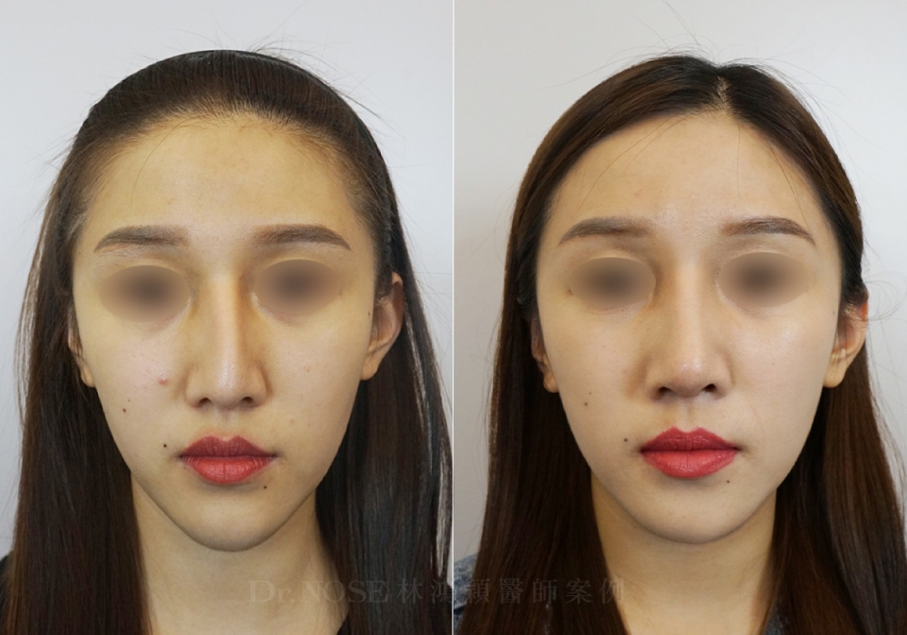 林鴻穎醫師隆鼻 各種鼻型調整 歪鼻手術 林鴻穎醫師隆鼻 各種鼻型調整 歪鼻手術